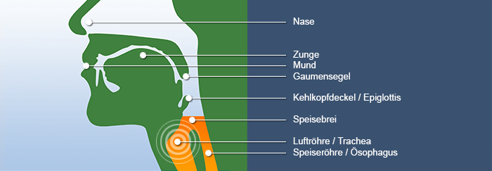 Schaubild Schluckbeschwerden